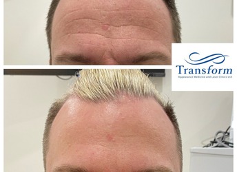 Anti Wrinkle to freshen up the forehead. This treatment is very popular among men. Product placement is very important to ensure a masculine look is retained and / or achieved.