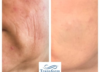 Lower face rejuvenation with Profhilo® and PDO Mono Threads