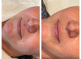Before and after 2x IPL fotofacials targeting melanin and haemaglobin (both brown and red pigmentation).