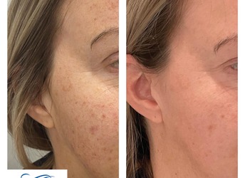 Before and after 1x Fotofacial