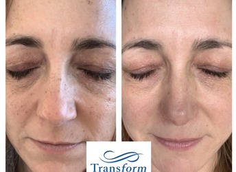 Before and after Fotofacial x1