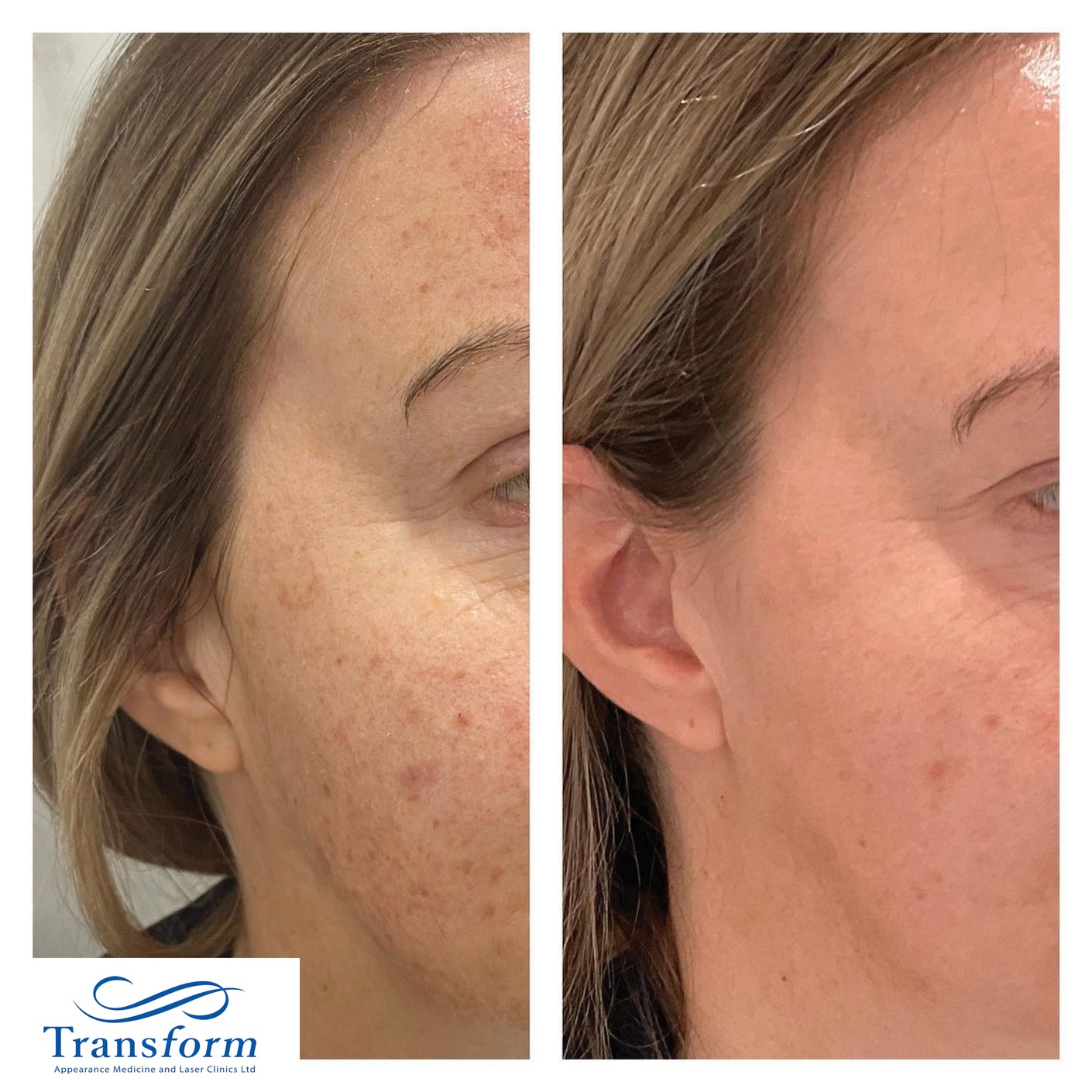 Before and after 1x IPL photofacial rejuvenation